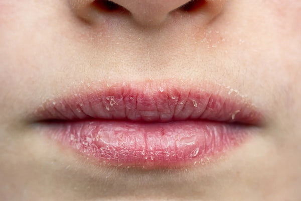 Can Dry Lips Be a Sign of Vitamin Deficiency?